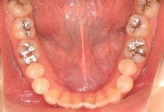 開咬：開咬の矯正 4 - セルフライゲーションブラケット装置（デイモンシステム）（上顎2本抜歯）