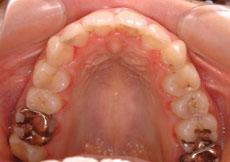 叢生（八重歯、乱ぐい歯）：叢生の矯正 6 - 上下舌側矯正装置（非抜歯）