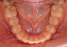 叢生（八重歯、乱ぐい歯）：叢生の矯正 6 - 上下舌側矯正装置（非抜歯）