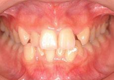 叢生（八重歯、乱ぐい歯）：叢生の矯正 6 - 上下舌側矯正装置（非抜歯）