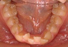 叢生（八重歯、乱ぐい歯）：叢生の矯正 6 - 上下舌側矯正装置（非抜歯）