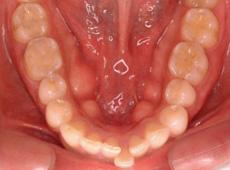 過蓋咬合：過蓋咬合の矯正 3 - 上下舌側矯正装置 （上下ディスキング）
