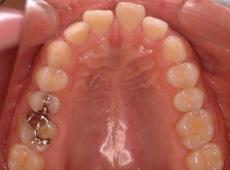 過蓋咬合：過蓋咬合の矯正 3 - 上下舌側矯正装置 （上下ディスキング）