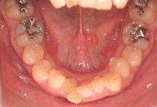 過蓋咬合：過蓋咬合の矯正 2 - セルフライゲーションブラケット装置（デイモンシステム）（2本抜歯）