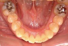 過蓋咬合：過蓋咬合の矯正 2 - セルフライゲーションブラケット装置（デイモンシステム）（2本抜歯）