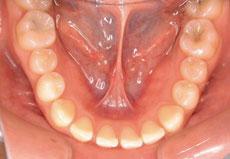 開咬：開咬の矯正 2 - セルフライゲーションブラケット装置（デイモンシステム）（上下左右4本抜歯）
