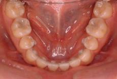 開咬：開咬の矯正 2 - セルフライゲーションブラケット装置（デイモンシステム）（上下左右4本抜歯）
