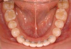 過蓋咬合：過蓋咬合の矯正 1 - セルフライゲーションブラケット装置（デイモンシステム）（2本抜歯）