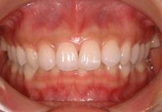 過蓋咬合：過蓋咬合の矯正 1 - セルフライゲーションブラケット装置（デイモンシステム）（2本抜歯）