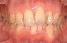 特殊症例：特殊症例 5 - 片方裏側の装置 （上下左右4本抜歯、上顎は左右非対称の抜歯）