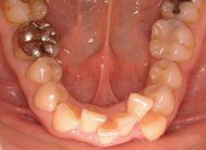 特殊症例：特殊症例 5 - 片方裏側の装置 （上下左右4本抜歯、上顎は左右非対称の抜歯）