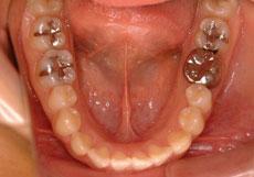 特殊症例：特殊症例 4 - 片方舌側矯正装置
