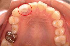 特殊症例：特殊症例 3 - セルフライゲーションブラケット装置（デイモンシステム）（上下左右4本抜歯、上顎は左右非対称の抜歯）