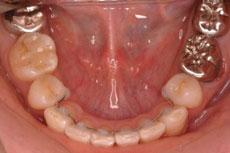 特殊症例：特殊症例 3 - セルフライゲーションブラケット装置（デイモンシステム）（上下左右4本抜歯、上顎は左右非対称の抜歯）