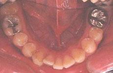 特殊症例：特殊症例 2 - セルフライゲーションブラケット装置（デイモンシステム）（非抜歯、下顎前歯1本先天性欠損）