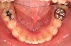 特殊症例：特殊症例 2 - セルフライゲーションブラケット装置（デイモンシステム）（非抜歯、下顎前歯1本先天性欠損）