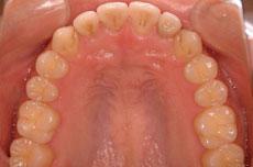 特殊症例：特殊症例 1 - セルフライゲーションブラケット装置（デイモンシステム）（非抜歯、下顎に歯科矯正用アンカースクリュー2本埋入）