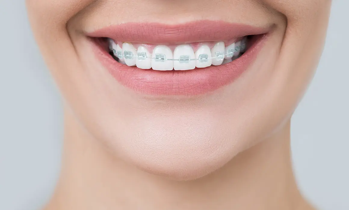 大人の矯正歯科（成人矯正）