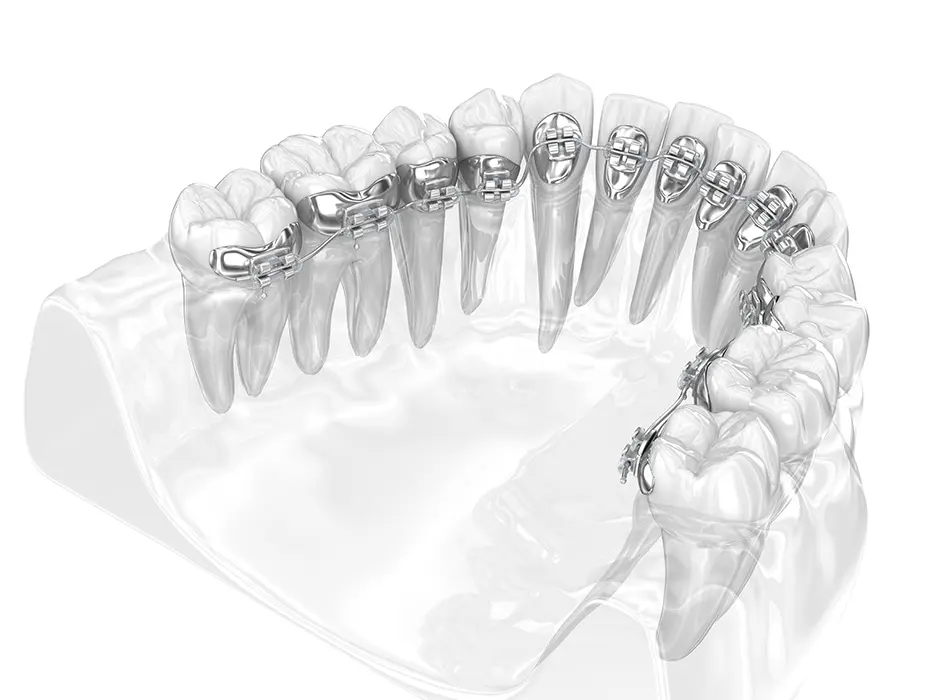 目立ちにくい、違和感を抑えられる カスタムメイド型リンガルブラケット矯正装置(WIN)