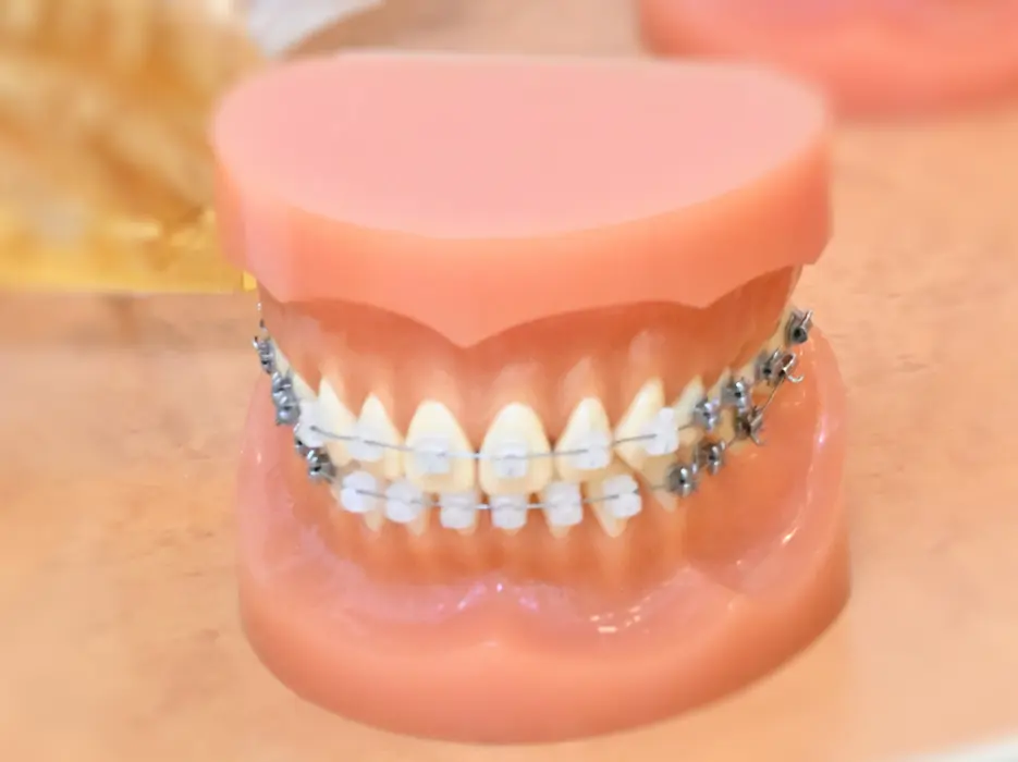 痛みを抑えられる セルフライゲーションブラケット装置(デイモンシステム)