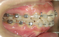 歯に直接装置を装着するシステム