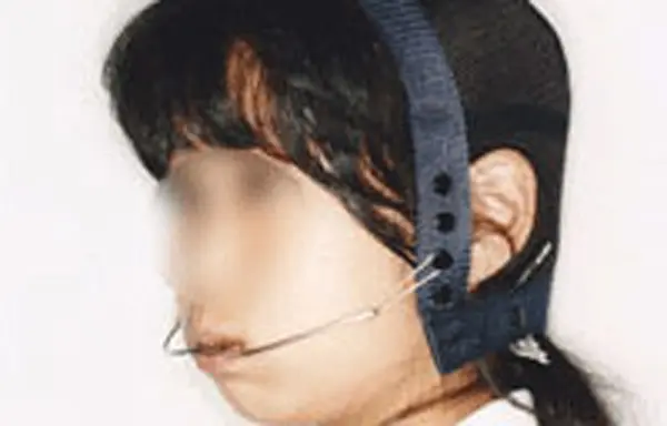 従来の補助的な装置ヘッドギア（※当院では使用いたしません。）