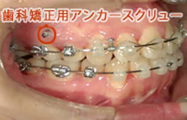 歯科矯正用アンカースクリュー