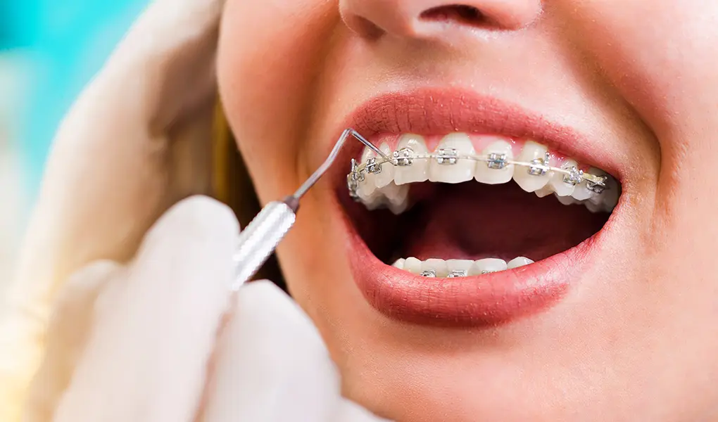 治療時に歯のクリーニングを実施