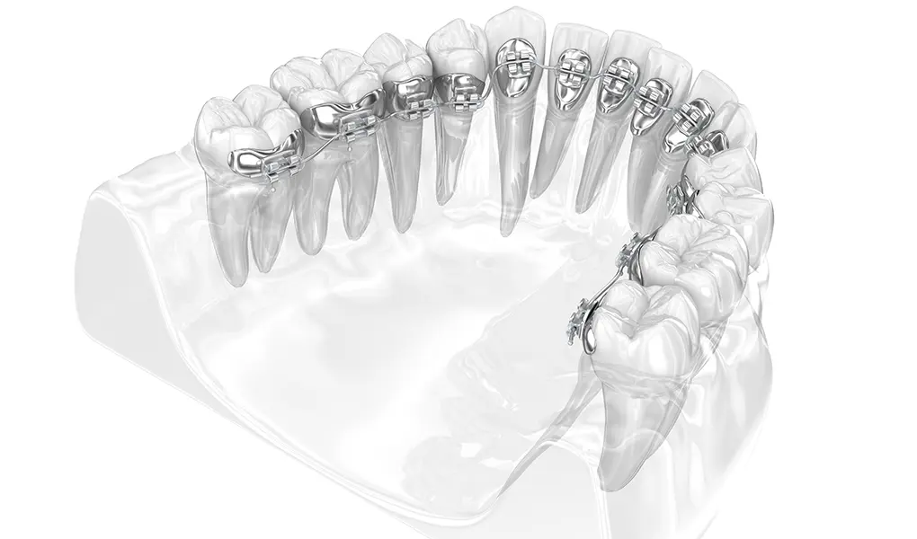 周りに気づかれにくい舌側矯正「カスタムメイド型リンガルブラケット矯正装置（WIN）」