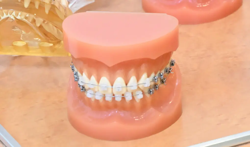 セルフライゲーションブラケット装置（デイモンシステム）