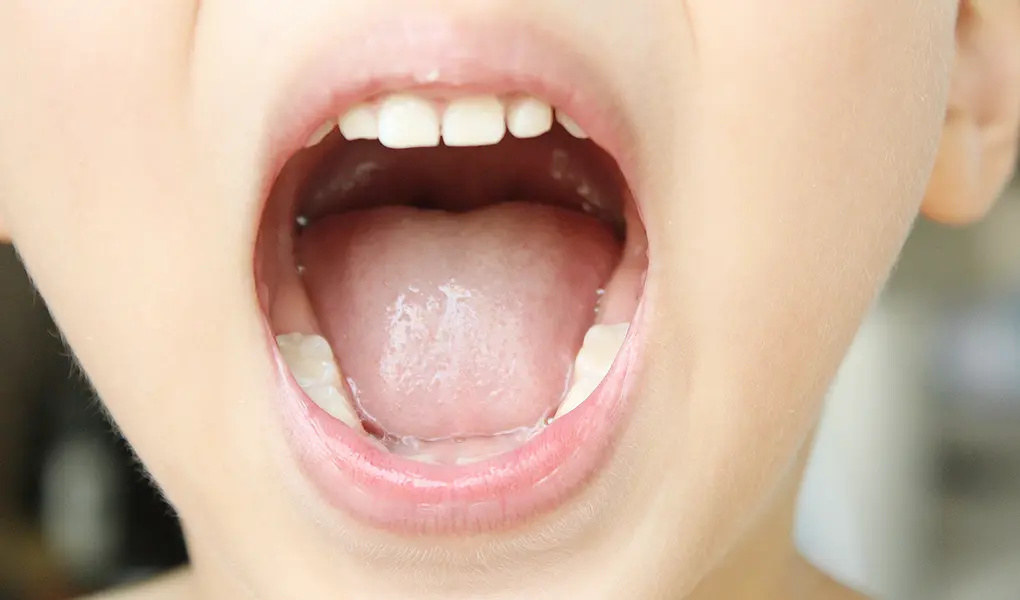 口腔筋機能療法