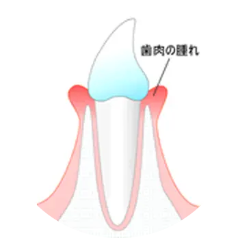 慢性の歯肉炎