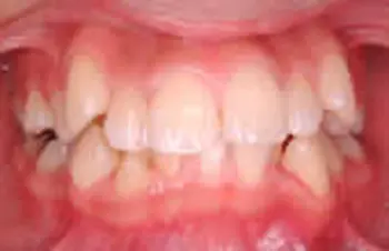 初期の歯周炎