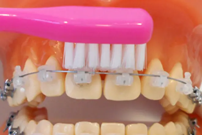 ワイヤーの下の歯に歯ブラシの毛先があたるように入れ、磨きます。