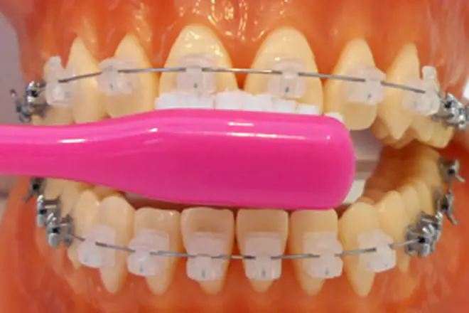 ワイヤーの下の歯に歯ブラシの毛先があたるように入れ、磨きます。