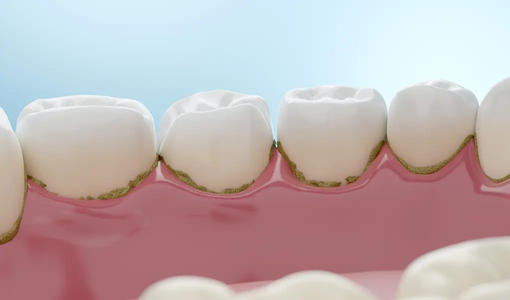 プラーク（歯垢）・歯石とは？