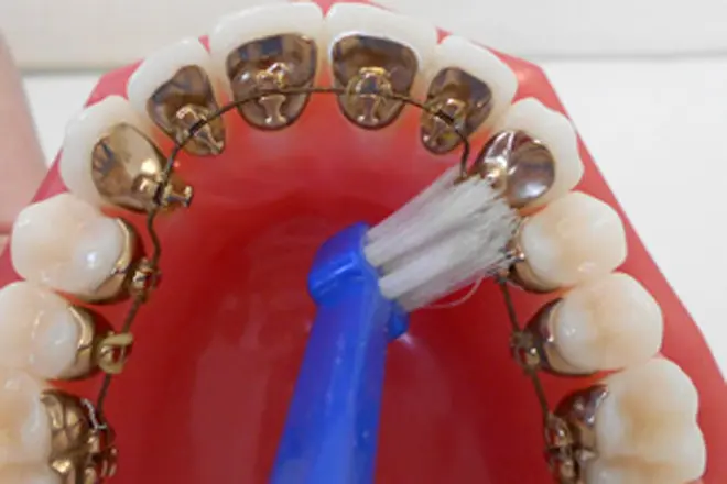 ワイヤーの下の歯に、歯ブラシの毛先があたるように入れ、磨きます。