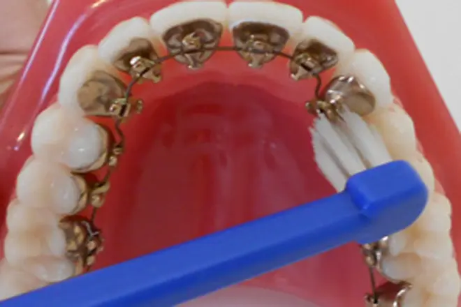 ワイヤーの下の歯に、歯ブラシの毛先があたるように入れ、磨きます。