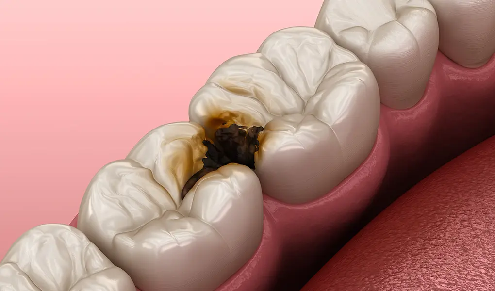 虫歯とは？
