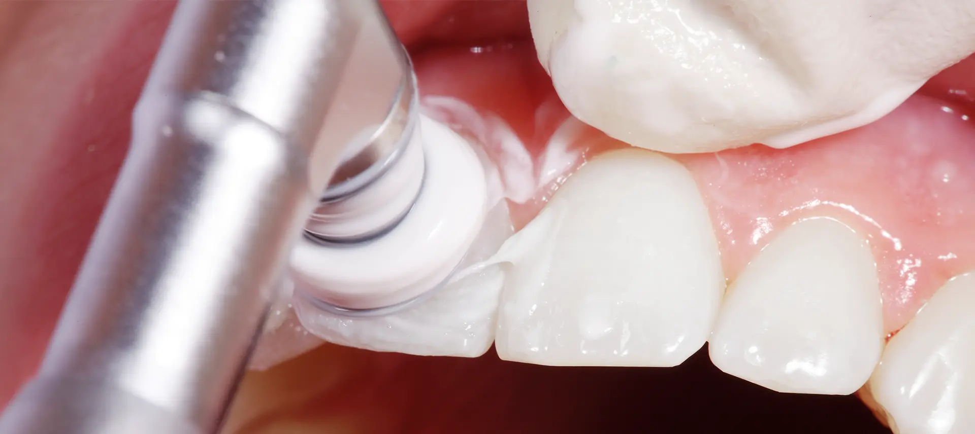 歯のクリーニング