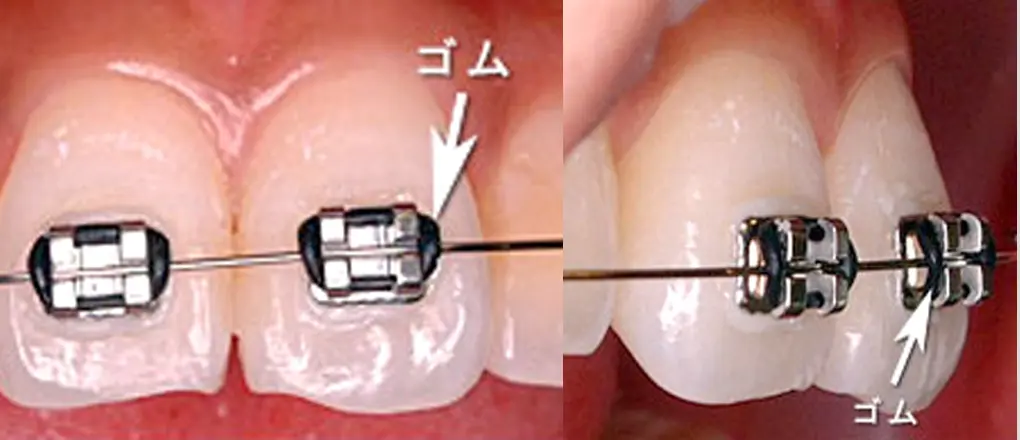 従来の矯正装置。ブラケットとワイヤーをゴムで留めています。