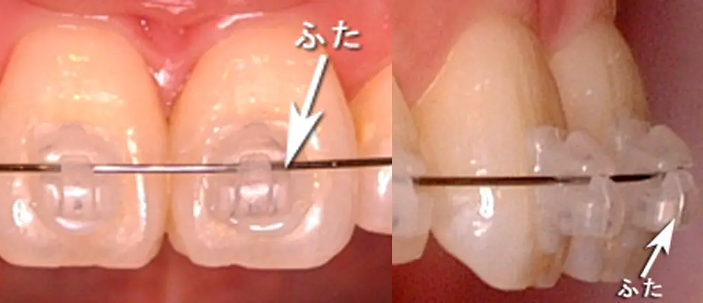 セルフライゲーションブラケット装置（デイモンシステム）。開閉式のふたにワイヤーを通しています。