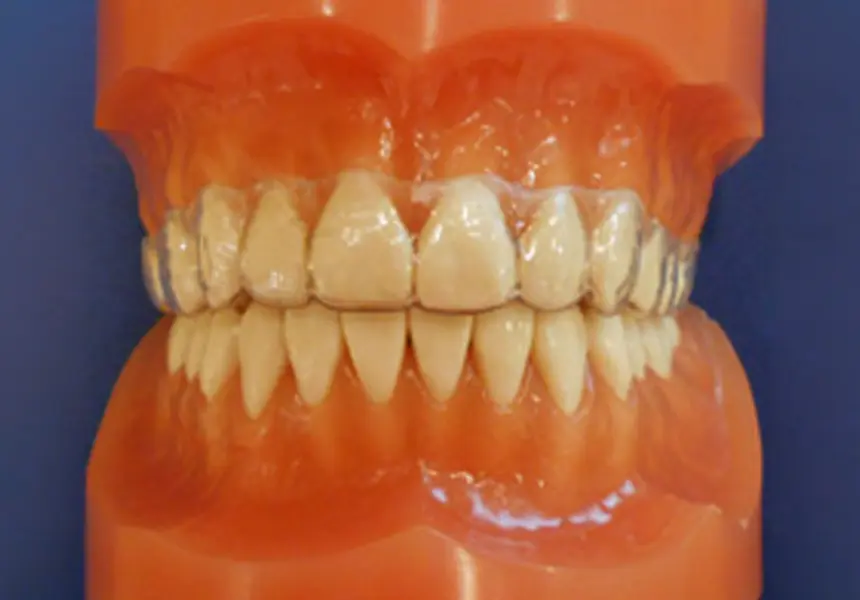 保定（約1～2年）