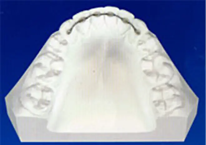 FSW（固定式リテーナー）