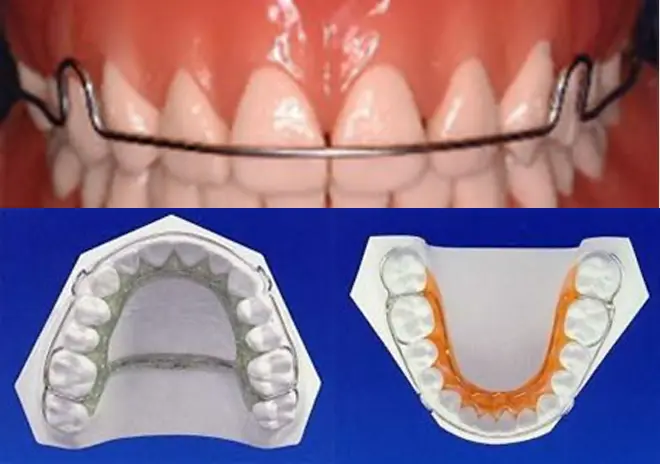 スリムリテーナー