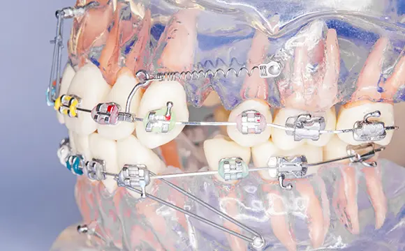 歯科矯正用アンカースクリューを用いた矯正治療の背景