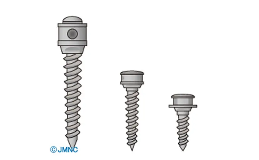 歯科矯正用アンカースクリュー（ISA：イミディエート・サージカル・アンカー）