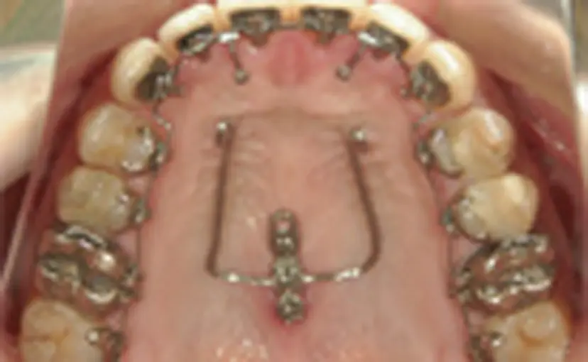 歯科矯正用アンカースクリュー（i-stationアイ・ステーション）