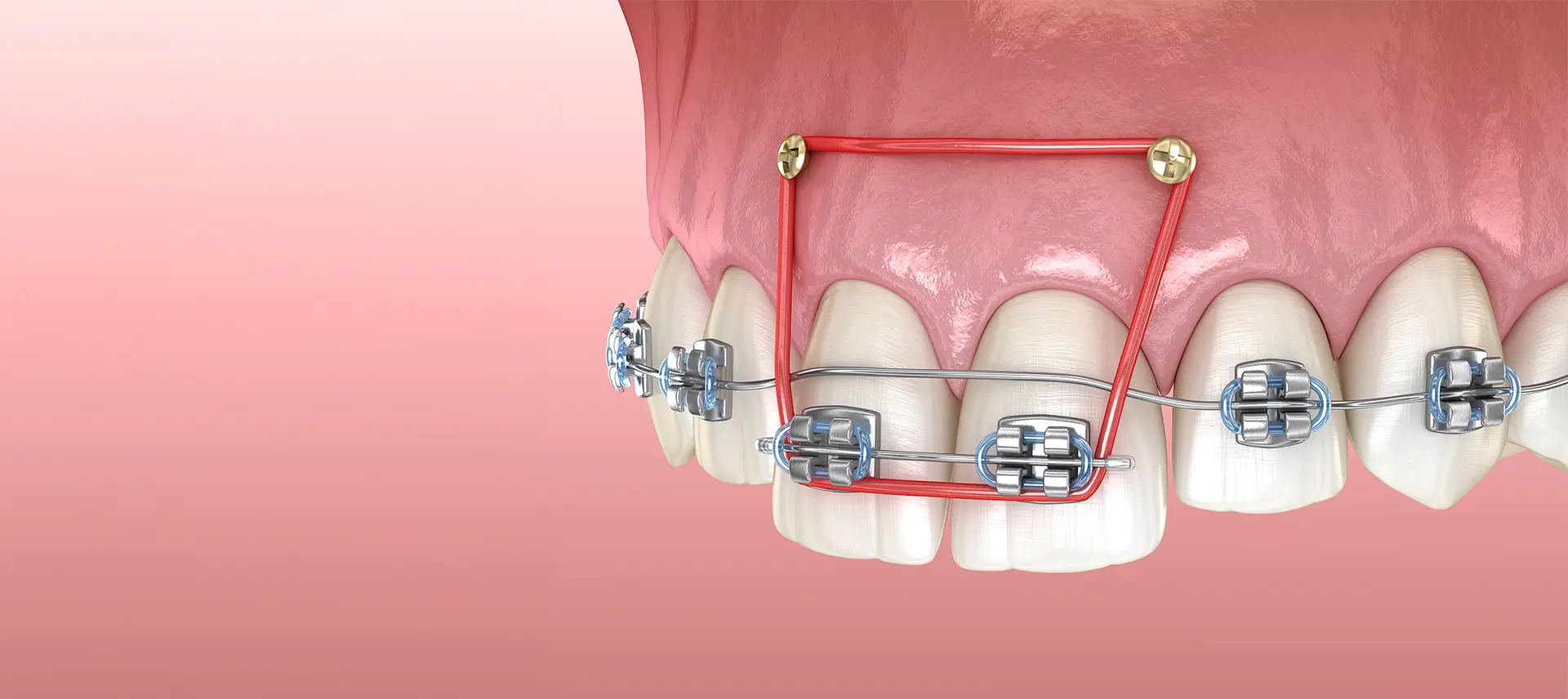 歯科矯正用アンカースクリューを用いた矯正治療