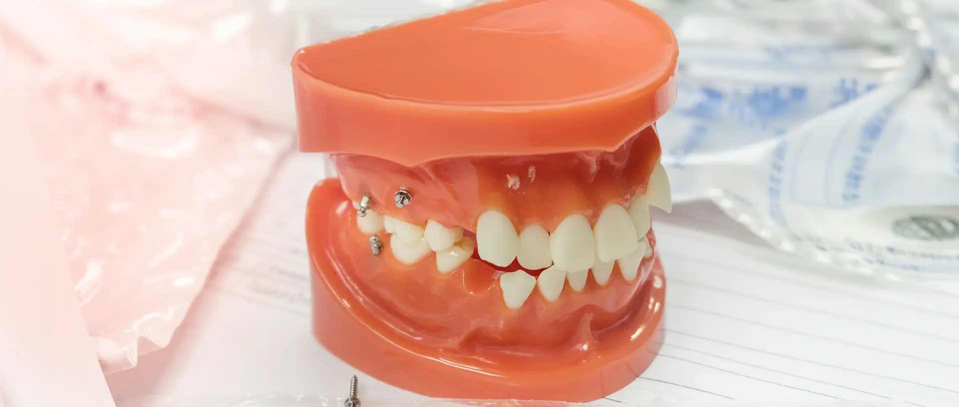 歯科矯正用アンカースクリューを用いた矯正治療とは